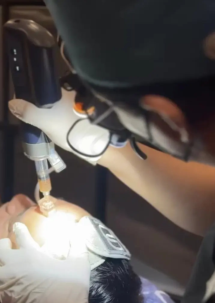 Doctor-performed treatment for acne scar revision at BienPoMD Aesthetics