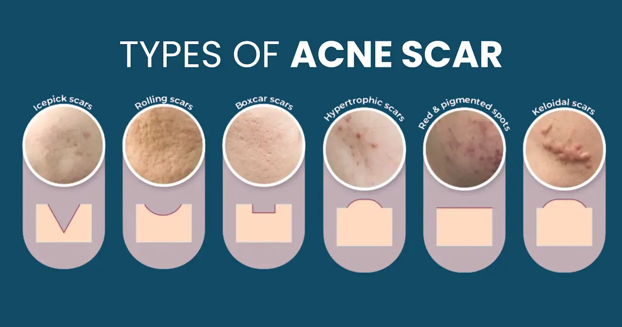 Different types of acne scars for acne scar revision at BienPoMD Aesthetics