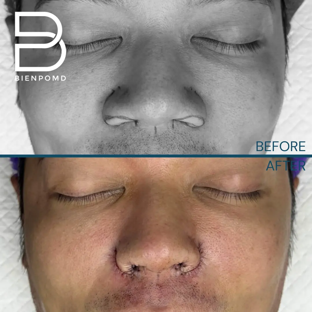 Frontal before-and-immediate-after Alarplasty Trifecta comparison with sutures visible