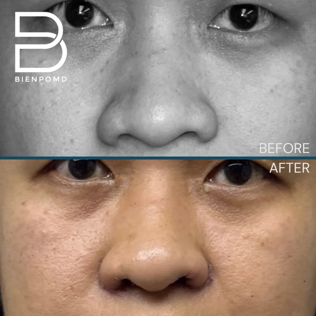 Alarplasty before and after patient result