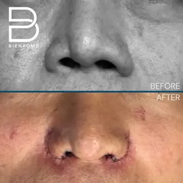 Improved asymmetric alar — comparison immediately after Alarplasty Trifecta.