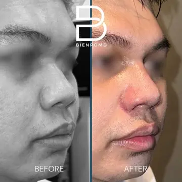One week transformation after Alarplasty Trifecta.