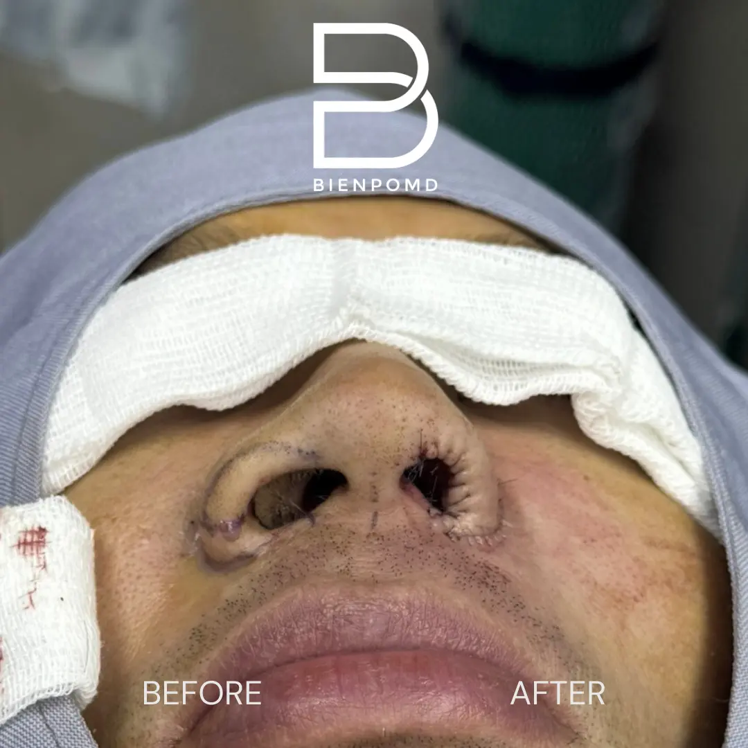 Intraoperative comparison after Alarplasty Trifecta.