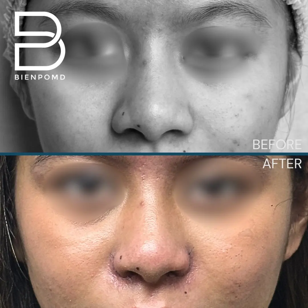 Alarplasty Trifecta one-week transformation.