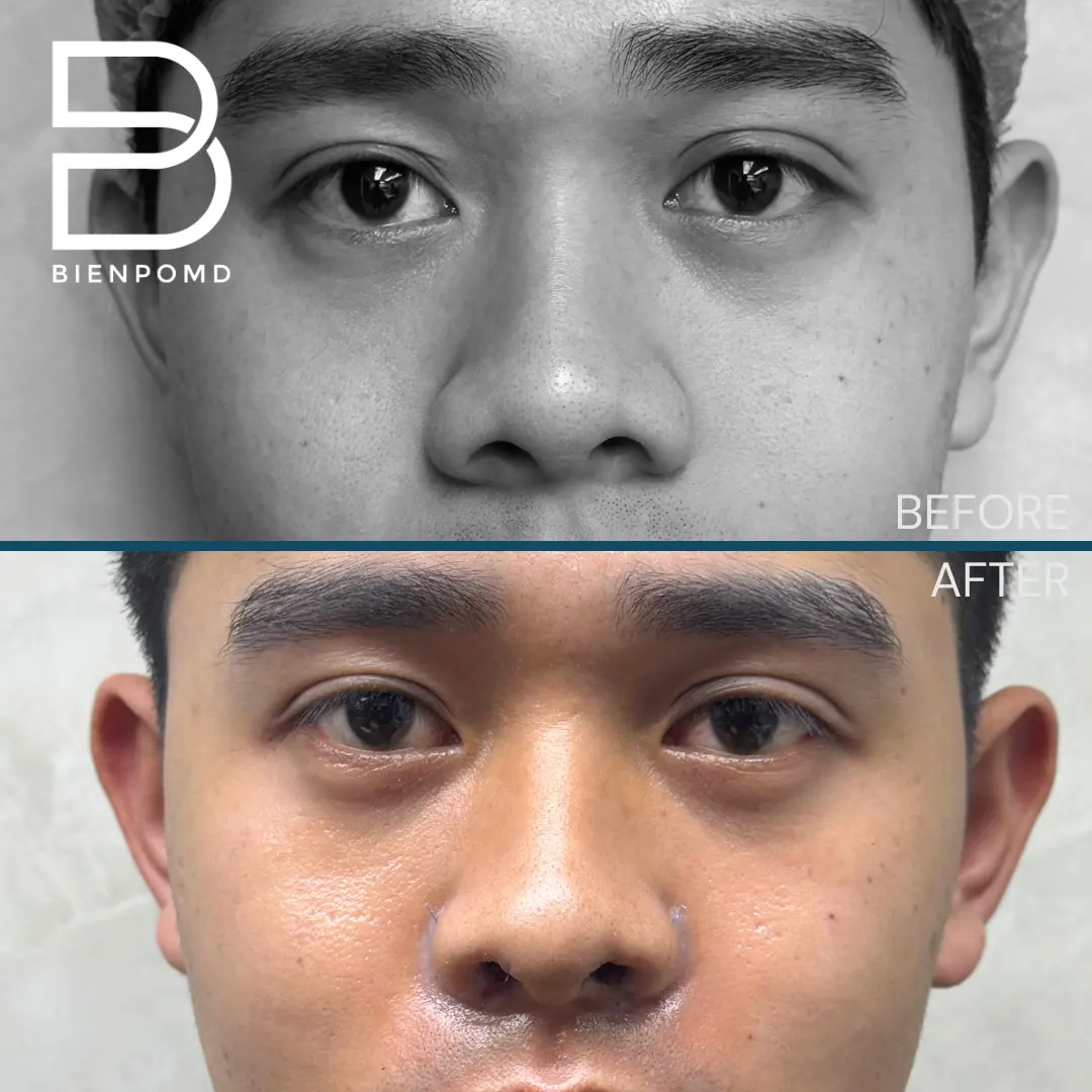 One week transformation after Alarplasty Trifecta — male patient.