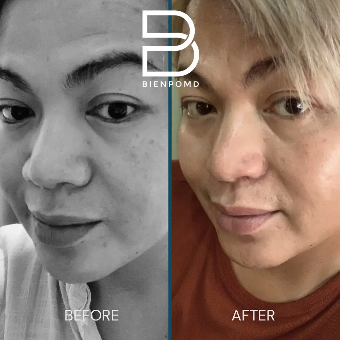 One-week transformation after Alarplasty Trifecta.