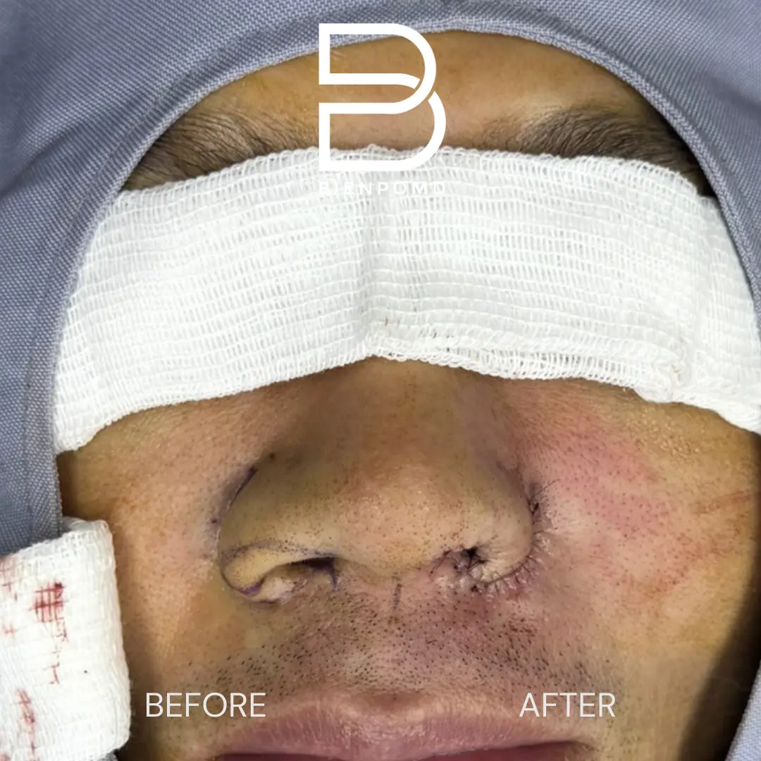 Intraoperative view comparing nostril base reduction, alar trim, and lift during Alarplasty Trifecta