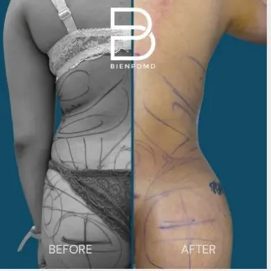 Brazilian Butt Lift before and after patient result