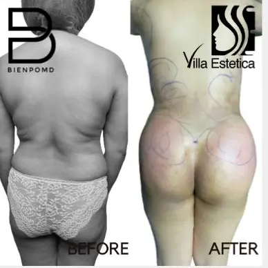 Brazilian Butt Lift before and after patient result