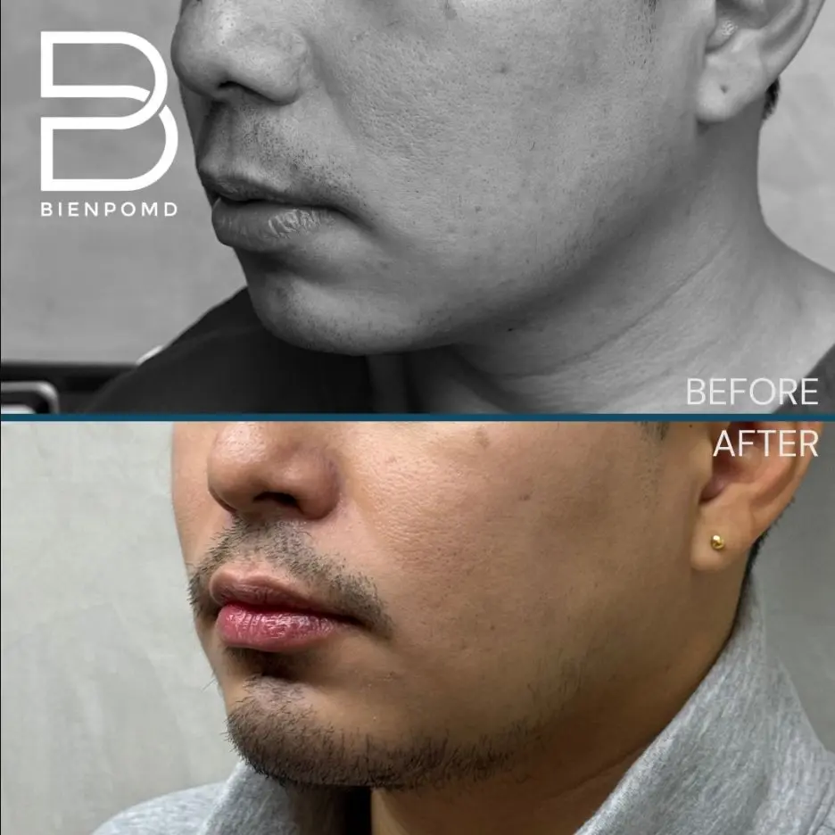 One-week transformation after Chin Augmentation.