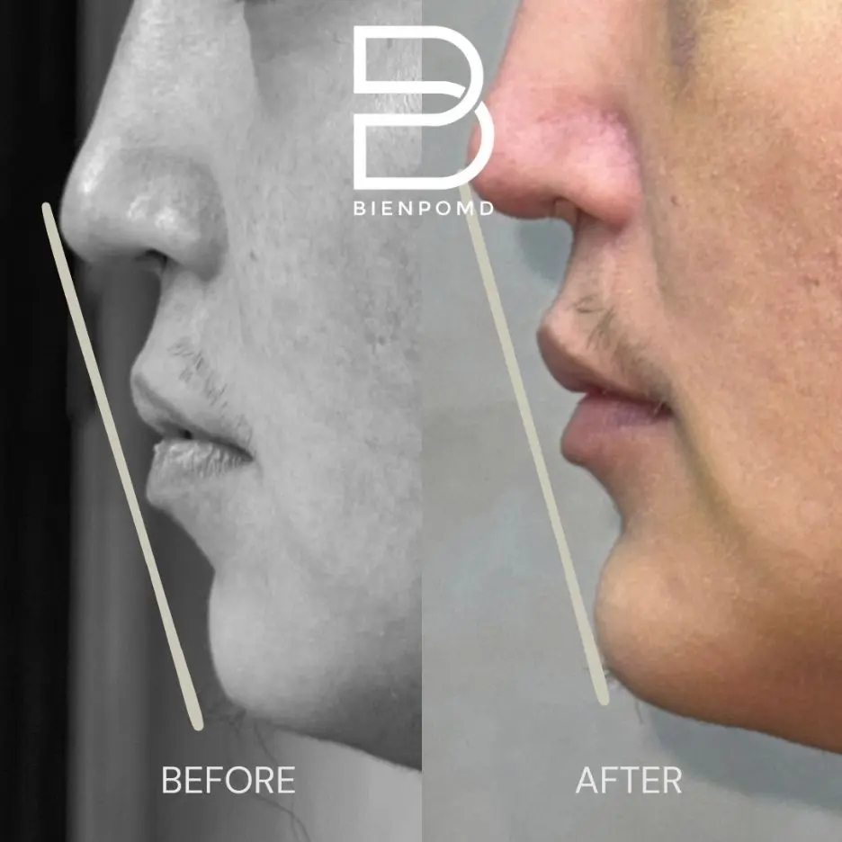 Immediate transformation after Chin Augmentation using a large implant.