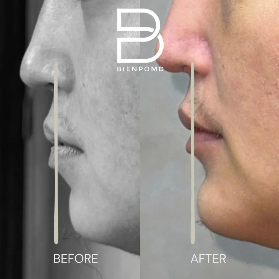Immediate transformation after Chin Augmentation using a large implant.