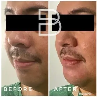 Immediate transformation after Chin Augmentation using a large implant.