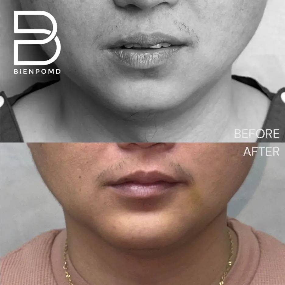 One-week transformation after Chin Augmentation using a medium extended implant.