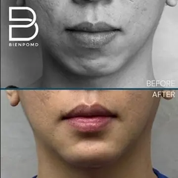 One-week transformation after Chin Augmentation using a large implant.