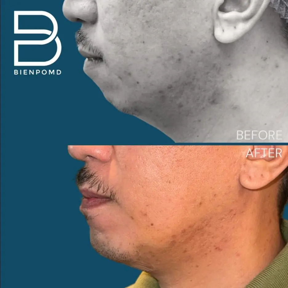 One-week transformation after Chin Augmentation using an extra-large implant.