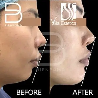 One-week transformation after Chin Augmentation using a medium implant.