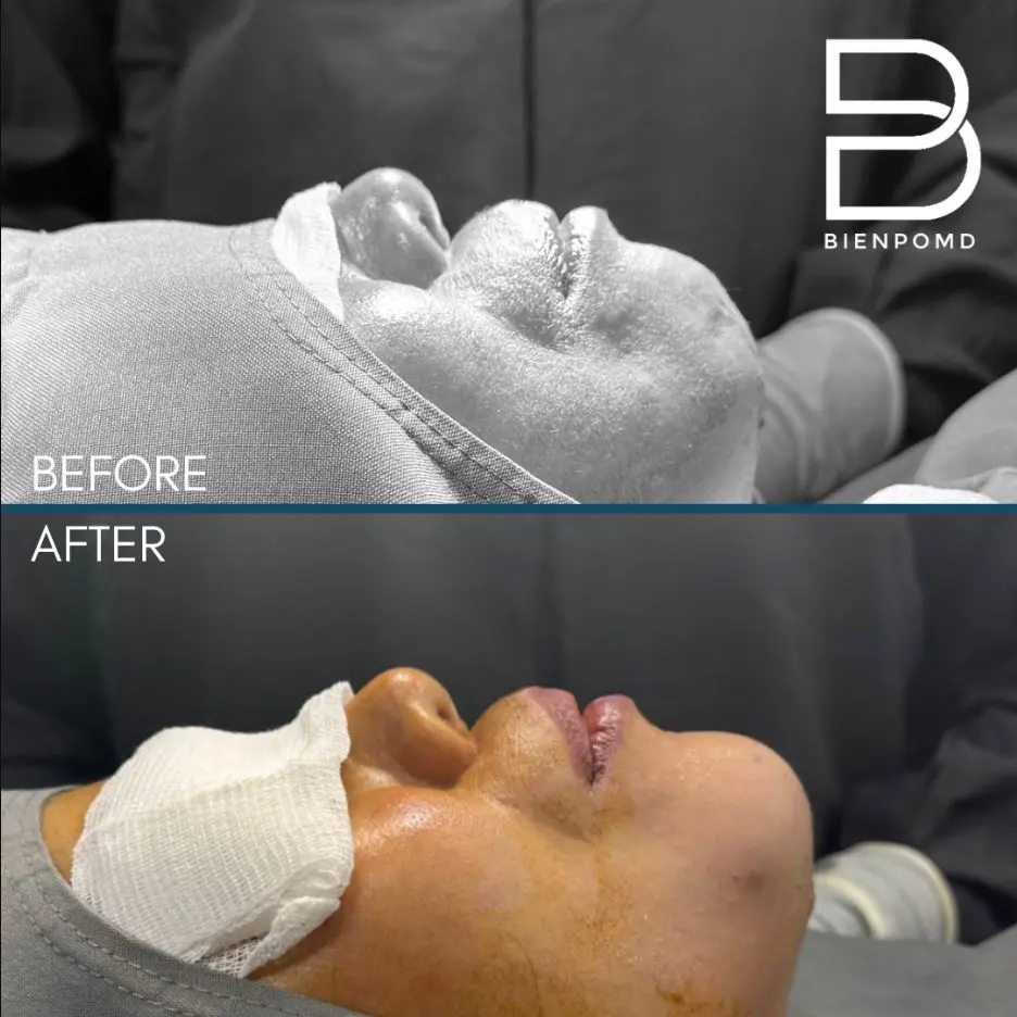 Immediate transformation after Chin Augmentation using a medium implant.