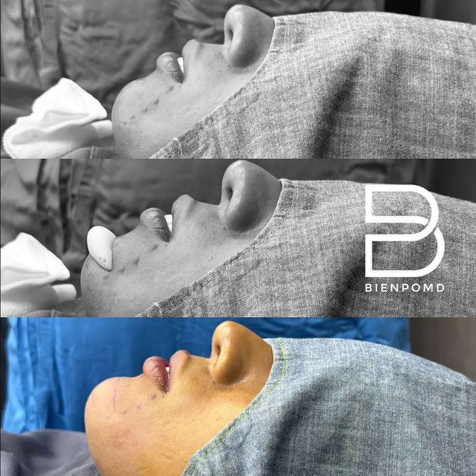 Immediate transformation after Chin Augmentation using a medium extended implant.
