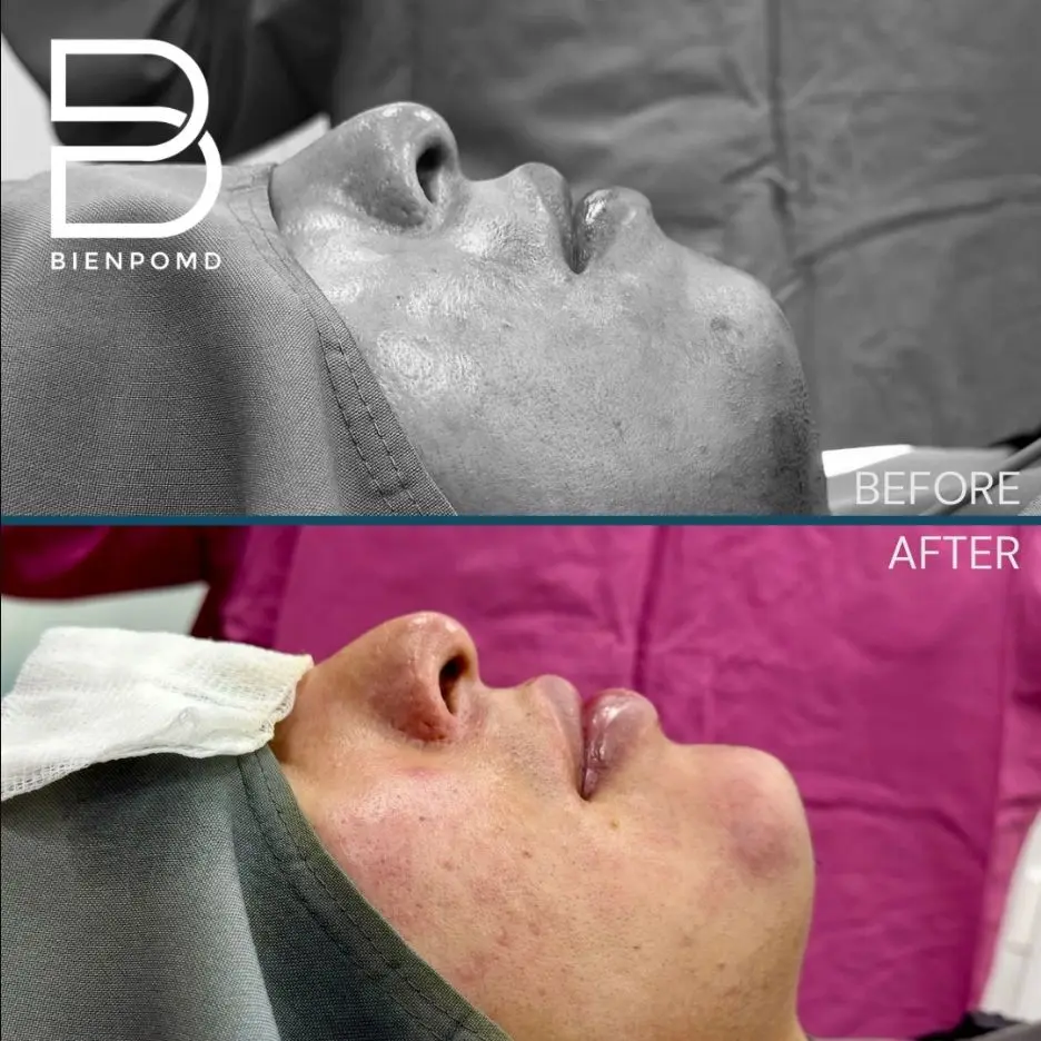Immediate transformation after Chin Augmentation using a large implant.