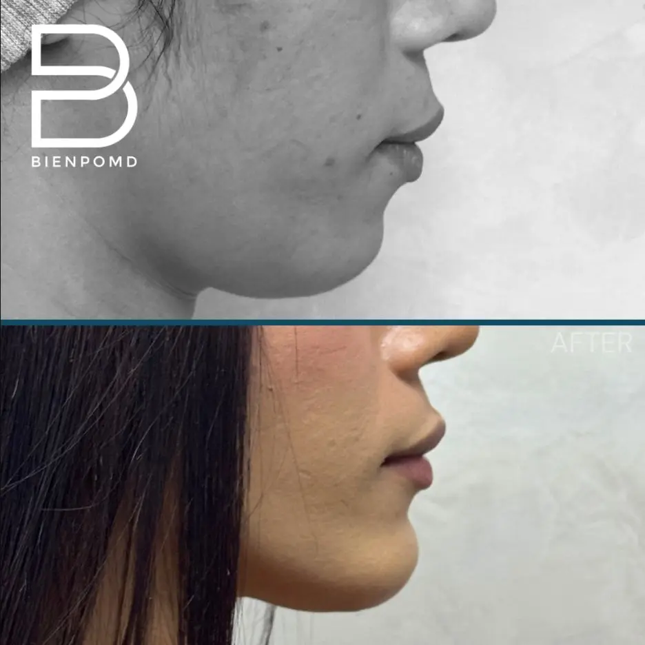 One-week transformation after Chin Augmentation using a medium extended implant.