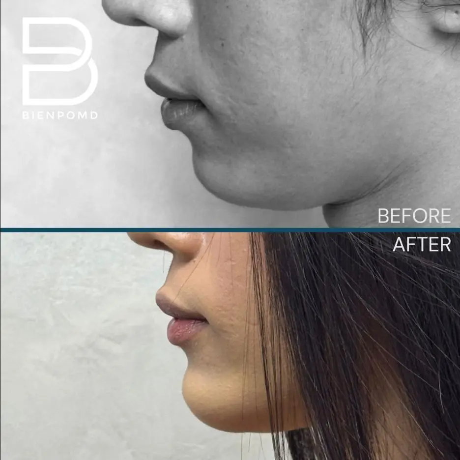 One-week transformation after Chin Augmentation using a medium extended implant.