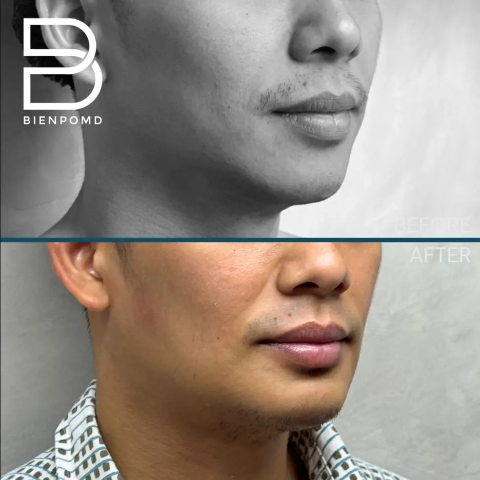 One-week transformation after Chin Augmentation using a large implant.