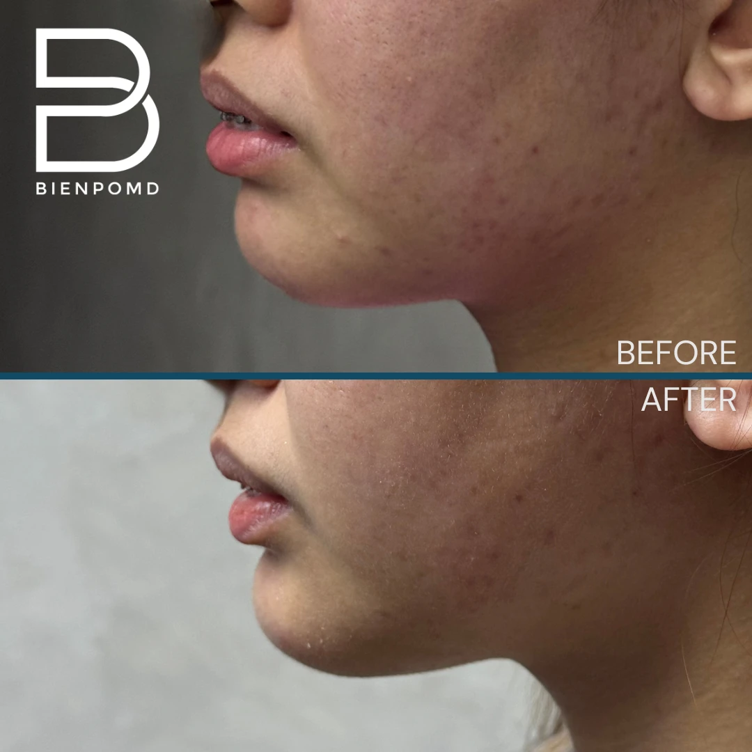 Chin Augmentation before and after patient result