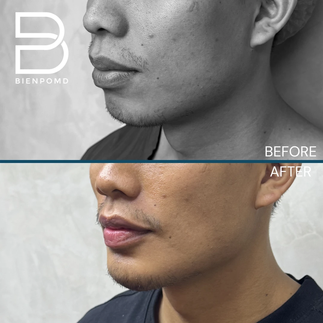 Chin Augmentation before and after patient result