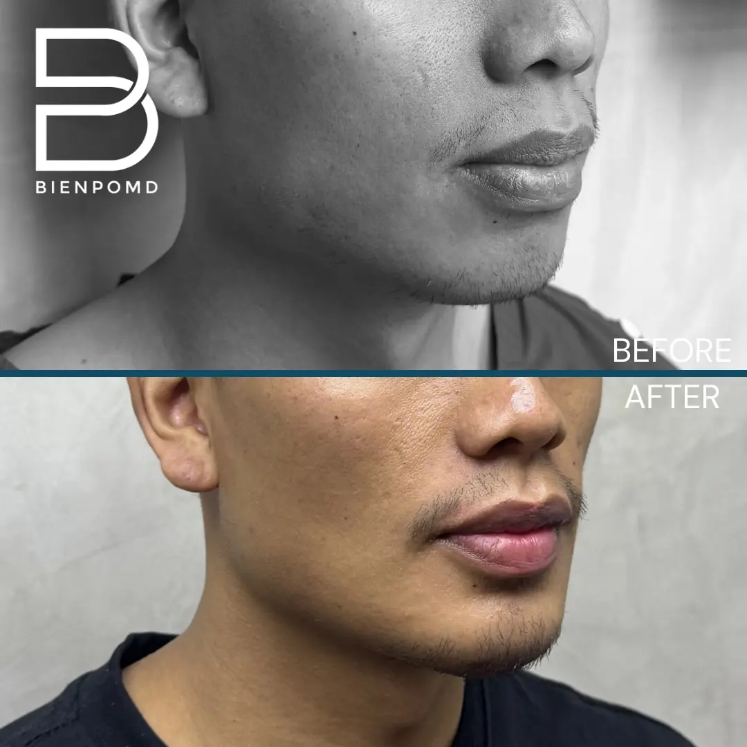 Chin augmentation before-and-after comparison, view 2
