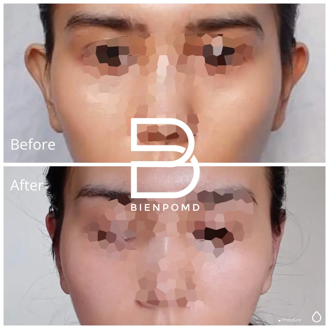 Transformation immediately after incisionless otoplasty.