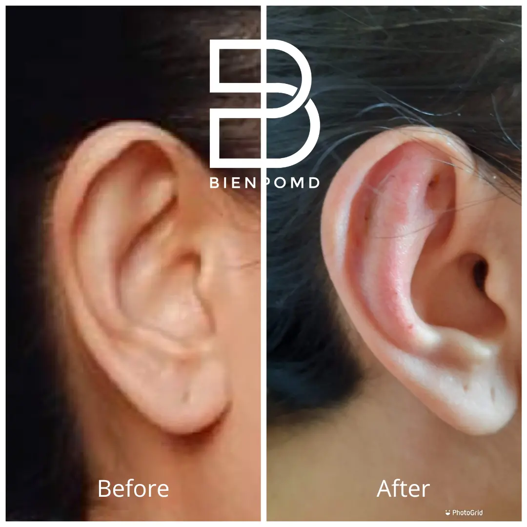 Transformation immediately after incisionless otoplasty.
