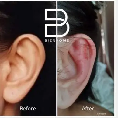 Transformation immediately after incisionless otoplasty.