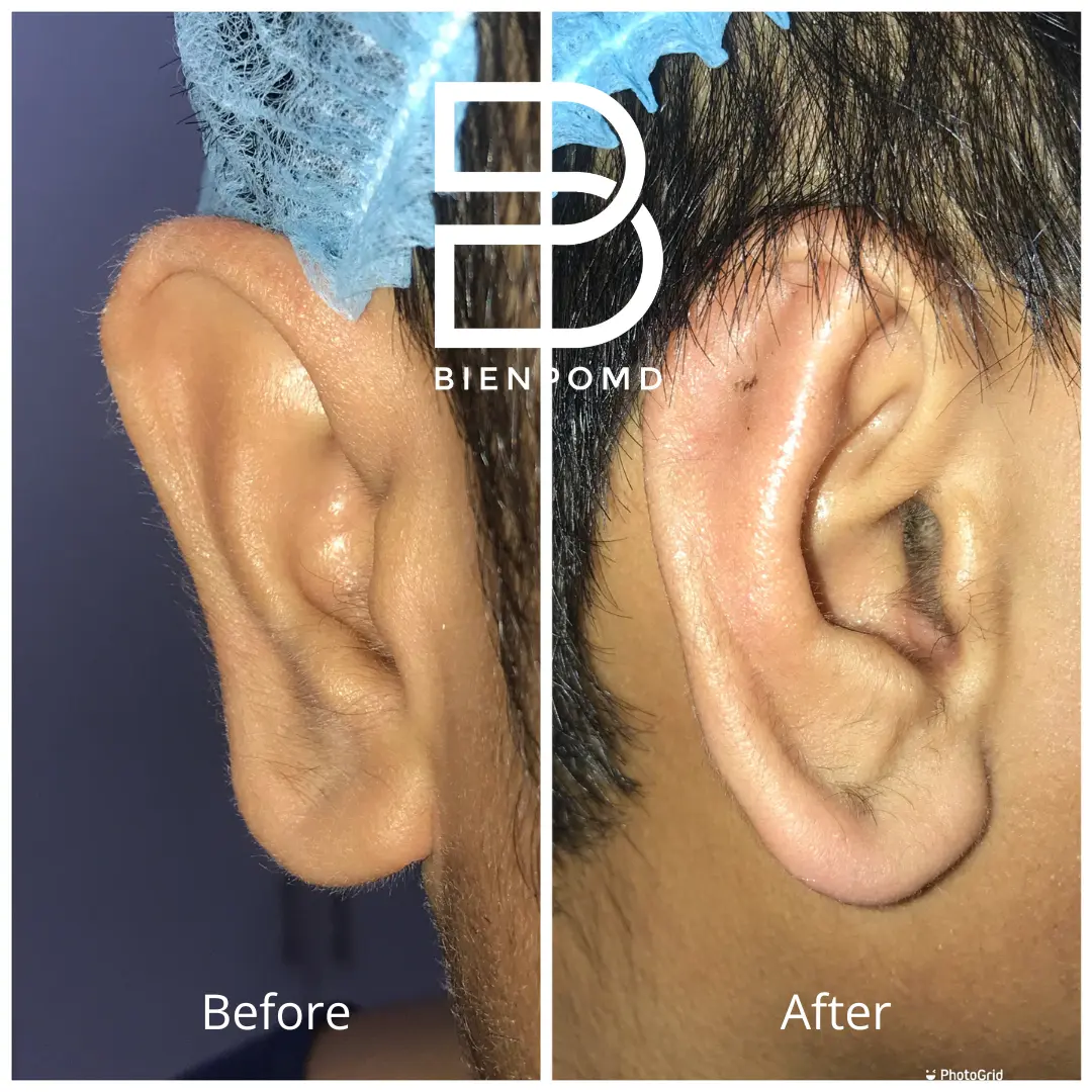 Transformation immediately after incisionless otoplasty.