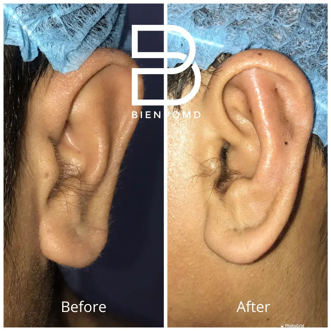 Transformation immediately after incisionless otoplasty.