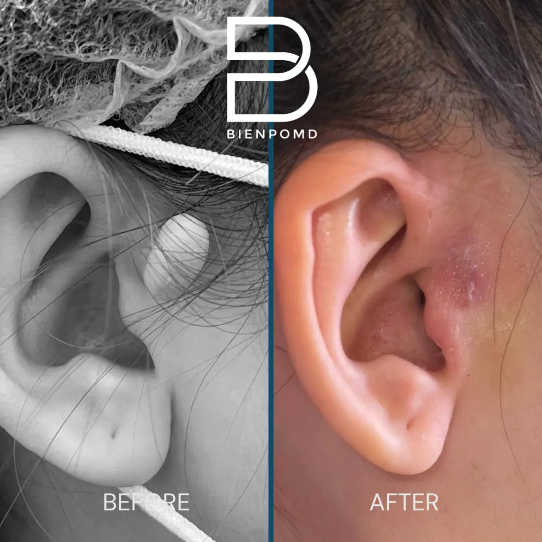 One-week transformation after ear tag or accessory tragus removal.