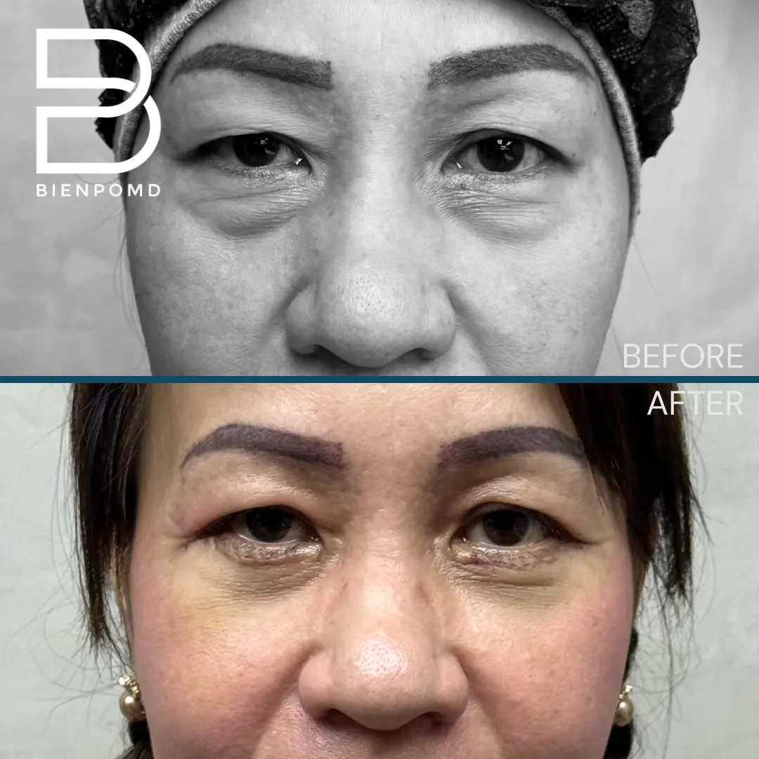 Eyebag Surgery before and after patient result