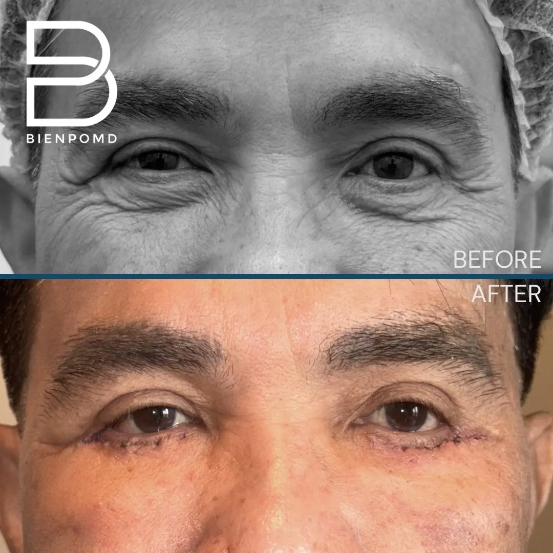 One-week transformation after Eyebag Removal Surgery.