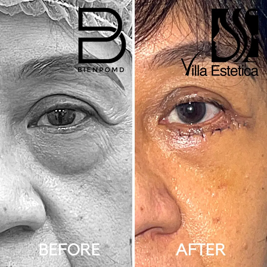 One-week transformation after Eyebag Removal Surgery.