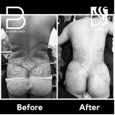 Fat Graft & Transfer before and after patient result