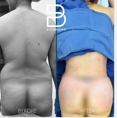 Fat Graft & Transfer before and after patient result