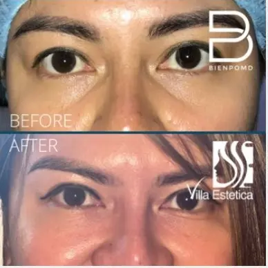 Fat Graft & Transfer results — published BienPoMD patient case 4