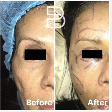 Fat Graft & Transfer results — published BienPoMD patient case 5