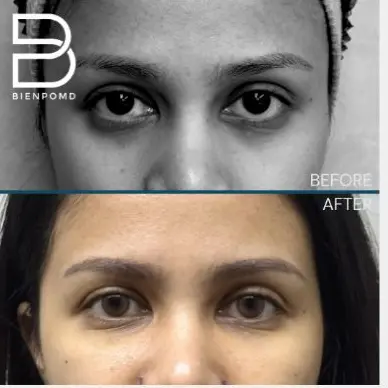 Fat Graft & Transfer results — published BienPoMD patient case 6