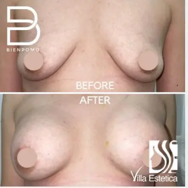 Fat Graft & Transfer results — published BienPoMD patient case 7