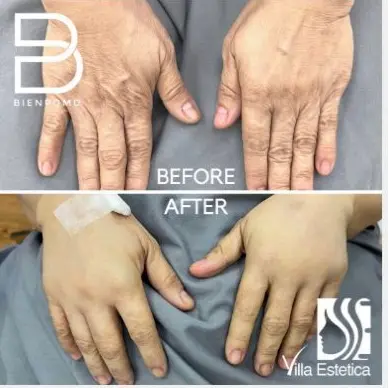 Fat Graft & Transfer results — published BienPoMD patient case 8