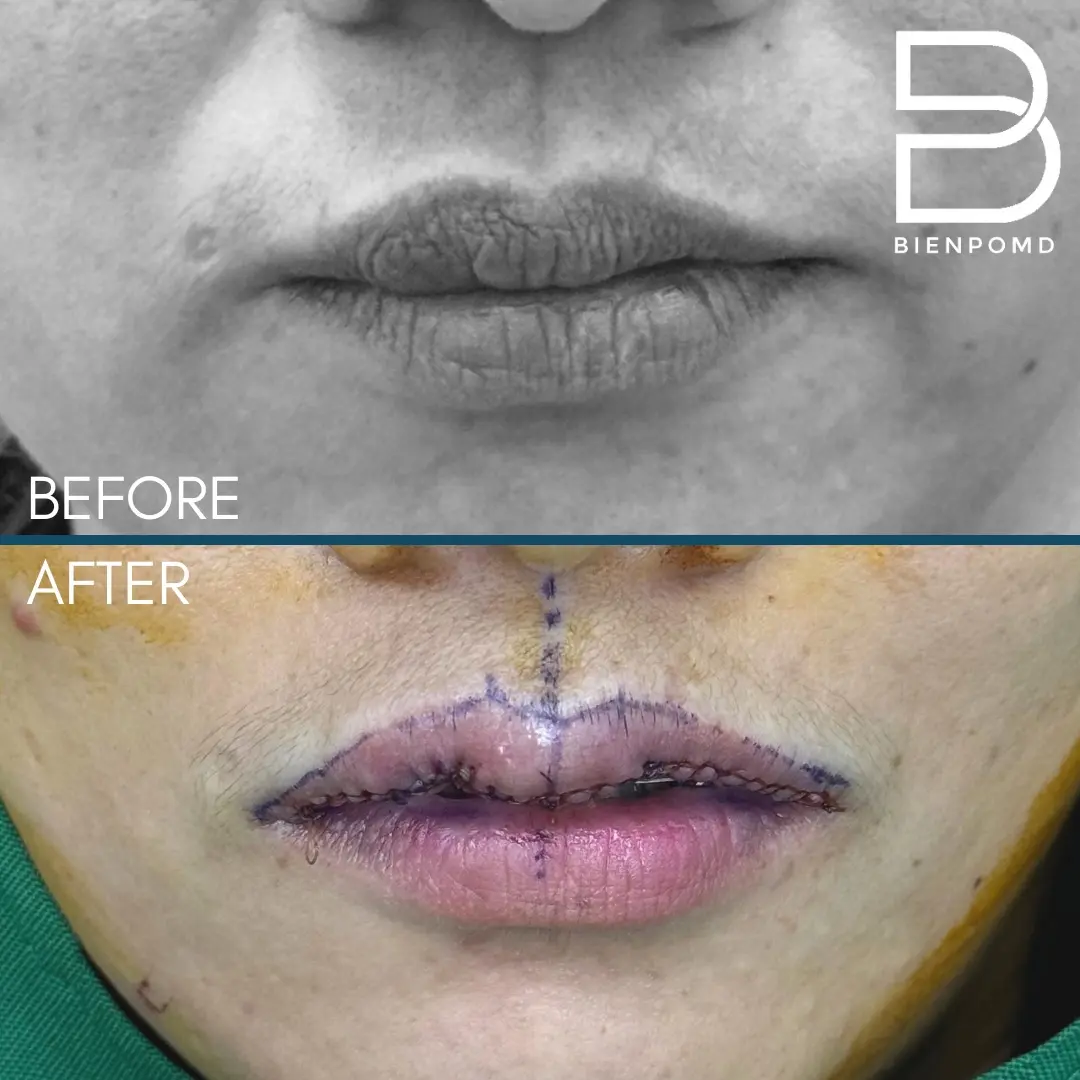 Transformation immediately after upper lip reshaping surgery.