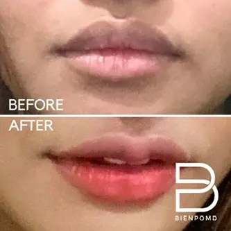 Two-week transformation after upper lip reduction and reshaping surgery.