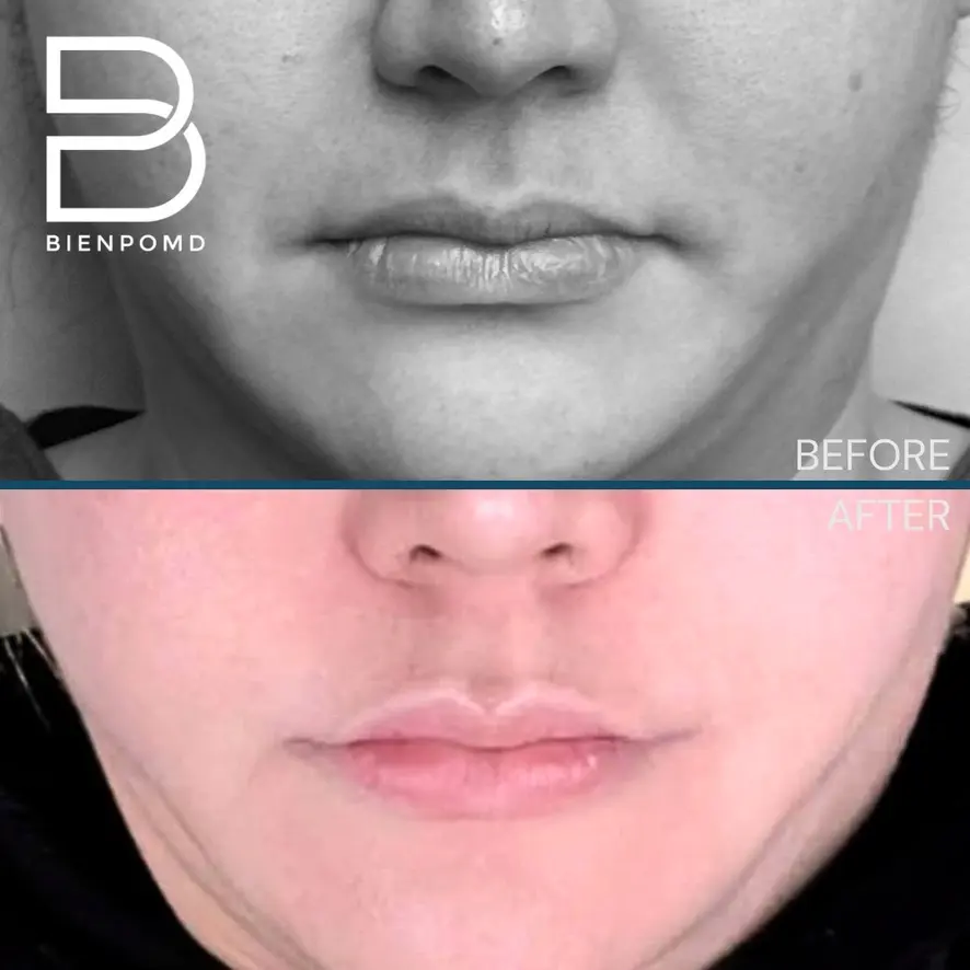Healing from Day 0 to Day 7 after Corner Lip Lift surgery.