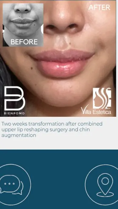 Two-week transformation after combined upper lip reshaping surgery and Chin Augmentation.